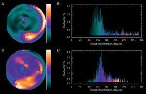 Fourier analysis of a gated myocardial perfusion single-photon emission computed tomography. Before resynchronization (A), the phase histogram amplitude increases abnormally. The polar map (B) shows that the greatest delay occurs in the inferior-lateral region of the left ventricle. After cardiac resynchronization therapy (C), the histogram amplitude (D) improves significantly. The patient improved clinically and left ventricular ejection fraction improved from 18% to 32% lower. (Images courtesy of Dr. Santiago Aguadé-Bruix, Hospital Universitari Vall d’Hebron, Barcelona.)