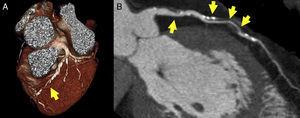 Stenosis of the left anterior descending artery in cardiac computed tomography study, visible (arrows) both in volumetric (A) and multiplanar reconstruction (B). The result has obvious prognostic and diagnostic implications.