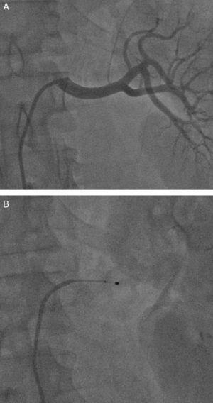 Renal denervation procedure. A: angiogram of left renal artery. B: radiofrequency ablation catheter in the artery.