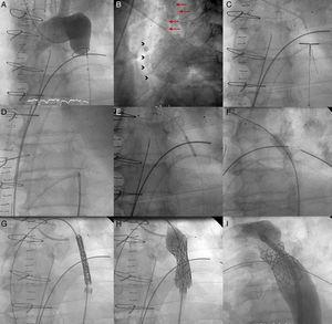 Coarctation with complete aortic obstruction and giant intercostal aneurysm (patient 1). A, aortography of the arch showing the complete obstruction with the snare in position; B, in the late phases, in 40° left anterior oblique view, large collateral vessel (arrows) that provides circulation into the descending aorta contrasted with a large intercostal aneurysm (arrowheads); C, perforation with Crossit 300 guide wire and insertion into the GooseNeck™ snare; D, guide wire captured with the snare and extraction establishing the radial-femoral line; E, expansion with 2mm×20mm Maverick coronary balloon catheter; F, inversion of the loop, positioning of the 0.035 guide wire, and expansion of the 8mm×20mm Balt balloon catheter; G, positioning the covered stent; H, expansion; I, outcome with good stent apposition to the wall.