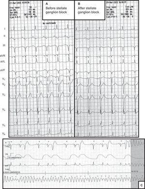 A: Electrocardiogram before sympathetic ganglion block. B: Electrocardiogram after sympathetic ganglion block; there is no significant reduction in the corrected QT interval. C: An example of the onset of sustained ventricular tachycardia.