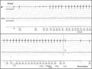 Ventricular tachycardia episode recorded by an implantable cardioverter-defibrillator. Onset of the episode (top) and its termination by a 5-J electric shock (below). Patient 1.