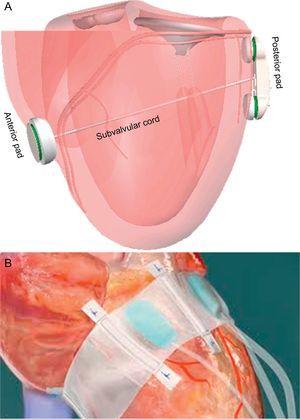Ventricular remodeling devices A: iCoapsys. B: Mardil-BACE. Adapted from Pedersen et al.55, with permission.