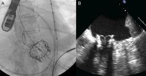 Implantation of a 29-mm Edwards-SAPIEN valve via the transapical approach in a 31-mm external diameter mitral annulus A: fluoroscopy image. B: transesophageal echocardiography.