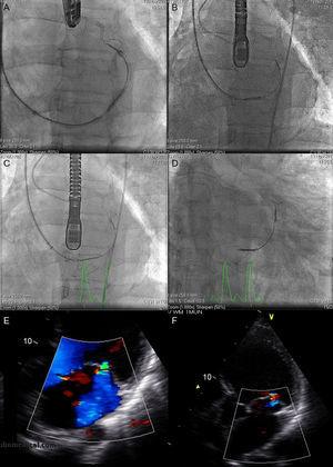 Fluoroscopy sequence of Carillon device implantation and echocardiographic findings A: distal anchor implantation. B: applying tension to the system with change in annulus size and catheter configuration. C: proximal anchor implantation to ensure tension in the system. D: released device. E: mitral regurgitation before the procedure. F: mitral regurgitation after the procedure. Courtesy of Dr. David Reuter (Seattle Children's Hospital, Seattle, United States).