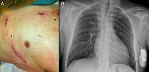 View of the patient's chest after implantation of the automatic subcutaneous implantable device (A) and anteroposterior X-ray at 24h post-implantation (B).