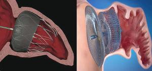 Percutaneous Left Atrial Appendage Occlusion | Revista Española De ...