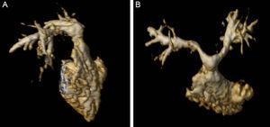 Three-dimensional volume rendering. Right lateral view (A) and anteroposterior view (B) of right ventricular outflow tract, showing supravalvular pulmonary stenosis and bilateral branch pulmonary artery stenosis.