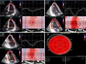 Strain profiles from three apical views. Speckle-tracking echocardiography analyses in the apical 4- (A), 2-chamber (B) and apical long-axis (C) view with the respective speckle-tracking echocardiography measurements. Average segmental values in each segment are used to generate a “bull's-eye” display of left ventricular myocardial deformation (D).