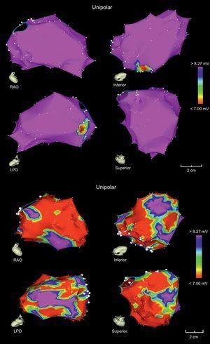 Electroanatomic map of the left ventricles of 2 patients with nonischemic dilated cardiomyopathy, whose unipolar voltage maps show a higher probability of reversibility (top) or irreversibility (bottom) of cardiomyopathy following ablation of premature ventricular complexes. LPO, left posterior oblique; RAO, right anterior oblique. Adapted with permission from Campos et al.18.