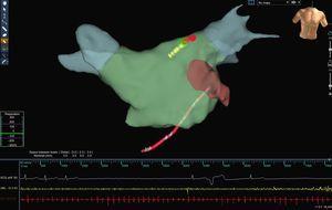 Anatomic reconstruction of the left atrium using the Ensite-NavX®. navigation system. A vagal response with significant node arrest can be observed during the application of radiofrequency to the region of the left superior ganglionated plexi (lesions marked in red) in a patient with persistent atrial fibrillation.