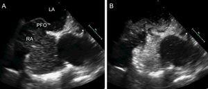 Diagnosis of patent foramen ovale after injection of agitated saline. A, transesophageal echocardiography. B, massive passage of bubbles after injection of agitated saline. PFO, patent foramen ovale; LA, left atrium; RA, right atrium.