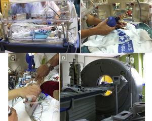 Procedure in a neonate with highly complex congenital heart disease. A: manual ventilation in transport cot. B: preparation before placement on 64-detector computed tomography table. C: situation on the table during final check of all the patient's leads and medication tubes. D: patient inside the image acquisition device.