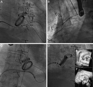 Closure of posterior paravalvular leakage on a mechanical mitral valve in the presence of bileaflet mechanical aortic prosthesis. A: the hydrophilic guidewire is advanced by anterograde access through the mitral paravalvular leak and into the aortic prosthesis. B: the guidewire is entrapped in the ascending aorta with a snare and externalized through a femoral artery to create an arteriovenous loop. C: this gives us sufficient push for the release sheath to pass. D: an Amplatzer Vascular Plug III 14/5 device is implanted. E: baseline 3-dimensional transesophageal echocardiography image. F: result postimplantation.