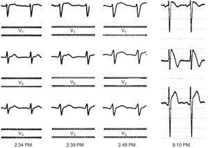 Right precordial leads (V1-V3) at 25mm/s and 10mV/mm. The tracings in the first 3 panels were obtained in the electrophysiology laboratory with an EP-WorkMate polygraph (St. Jude Medical). The fourth panel is a standard digital electrocardiogram obtained in the cardiology department.