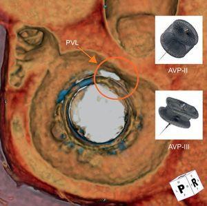 Three-dimensional reconstruction of cardiac computed tomographic angiography reveals a mitral bioprosthetic valve (en face view from the atrial side) with a crescentic shaped paravalvular leak (red circle) at the 11 to 12 o’clock location. The Amplatzer vascular plug III (oblong) may be more suitable for closure as it better conforms to the shape of the PVL, compared with the Amplatzer vascular plug II (round). AVP, Amplatzer vascular plug; PVL, paravalvular leak.