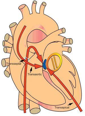 Diagrammatic representation of a paravalvular leak (blue) around a mechanical mitral valve (yellow) at the septal location (1-3 o’clock). Septal and posteriorly located leaks (1-6 o’clock) require step angulations of catheters and delivery sheaths from the antegrade transseptal and retrograde transaortic approaches. A percutaneous transapical approach provides direct access to both the aortic and mitral valves and reduces sharp catheter angulations and the need to transverse mechanical valves.