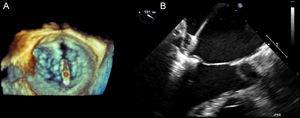 A: 3-dimensional echocardiography image with mitral clip open in the left atrium, where we can check its alignment with the coaptation plane of the mitral valve leaflets. B: image taken when closing the clip, grasping the mitral leaflets.