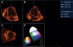 Three-dimensional transthoracic echocardiography of the left ventricle in an experimental infarction model, reformatted in 4-chamber (A), 2-chamber (B), and short-axis (C) views, and analysis of regional contractility (D), which shows apical hypokinesia (in white in the 3-dimensional model). The left ventricular volumes and left-ventricular ejection fraction are shown in the right column. EDV, end-diastolic volume; EF, ejection fraction; ESV, end-systolic volume; SV, stroke volume. Courtesy of Drs. C. Santos-Gallego and J. Badimón.