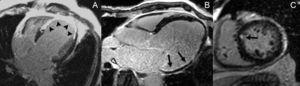 Visualization of the scar by late gadolinium enhancement. A: Septoapical transmural myocardial infarction (arrowheads) with no residual viability. B: Inferolateral subendocardial infarction (arrows) with extensive residual viability. C: Anteroseptal focal infarction (arrow).