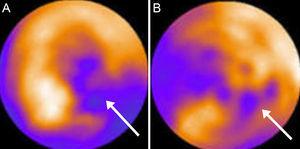 Polar map demonstrating discordance between decreased inferolateral perfusion at rest measured with rubidium-82 (A) and preserved metabolism measured with fluorodeoxyglucose-18 (B; arrows), which indicates viability. Courtesy of Dr. J. Machac.