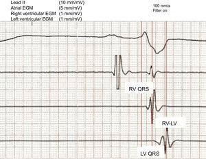 Intracavitary electrogram recording with the device programmer. EGM, electrogram; LV, left ventricle; LV QRS, interval between the onset of QRS and the intrinsic deflection of the bipolar left ventricle electrogram; RV, right ventricle; RV-LV, interval between the intrinsic deflections of the bipolar right ventricle and left ventricle electrograms; RV QRS, interval between the onset of QRS and the intrinsic deflection of the bipolar RV electrogram.