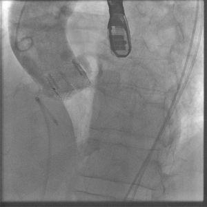 Absence of aortic insufficiency on aortography after transcatheter implantation of a 23-mm Lotus™.