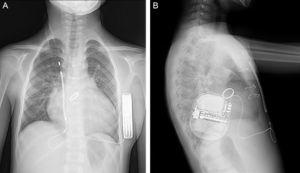 Posterior-anterior (A) and lateral (B) chest X-ray of the implanted device in the patient.