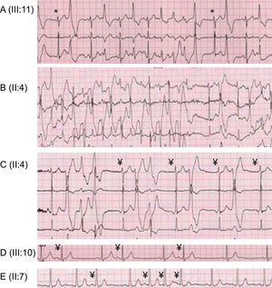 Ventricular and nonventricular arrhythmias during exercise testing. A: ventricular monomorphic bigeminy and bursts of nonsustained polymorphic ventricular tachycardia (*junctional escape). B: bidirectional nonsustained ventricular tachycardia. C: ventricular premature beats, nonsustained polymorphic ventricular tachycardia, polymorphic ventricular couplet, monomorphic ventricular bigeminy, and atrial ectopic rhythm (¥). D: atrial bigeminy (¥). E: atrial premature beats isolated and in salvos (¥).