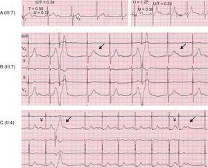 U-wave features in catecholaminergic polymorphic ventricular tachycardia patients. A: resting U-wave (left) and on exertion (right). A fixed, short PR interval suggests an accelerated atrioventricular conduction (left). B: transient increase in U-wave amplitude in the first beat after a ventricular premature beat (arrows) on exertion. A junctional rhythm competes with sinus rhythm. C: transient increase in U-wave amplitude on exertion associated to premature beats, either atrial (right arrow) or ventricular (left arrow).