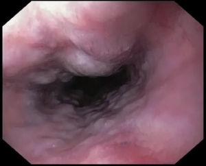 Grade III esophageal varices visualized by endoscopic ultrasound.