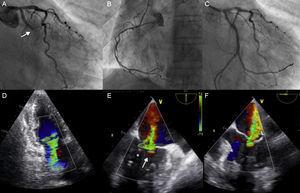 A: Coronary angiography showing the thrombotic occlusion of the circumflex artery (arrow). B: The right coronary artery did not show significant stenosis. C: Angiographic result following percutaneous treatment of the artery causing infarction. D: Transthoracic echocardiography showing severe mitral regurgitation. E and F: Transesophageal echocardiogram showing severe mitral regurgitation with predominant central regurgitation (arrow), although with a certain degree of medial involvement (asterisk).