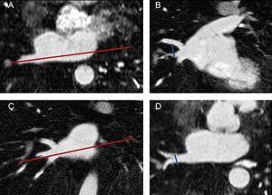 Measurement of pulmonary vein diameters. Long-axis of the pulmonary vein in an axial plane (A). The superoinferior diameter of each pulmonary vein was measured in an oblique coronal image reconstruction (B) based on the plane showed in A. Long axis of the pulmonary vein in a coronal plane (C). The anteroposterior diameter was measured in an oblique axial image (D) based on the plane showed in C. The pulmonary vein ostium was defined as the point of inflection between the left atrium wall and the pulmonary vein wall.