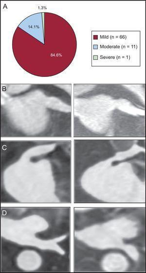 Pulmonary vein stenosis. A: frequency of stenosis according to the cross sectional area reduction percentage (mild < 50%; moderate: 50-70%; severe: > 70%). B-D: gadolinium enhanced 3-dimensional magnetic resonance imaging sequence reformations. B: mild stenosis of a left superior pulmonary vein, oblique coronal plane. C: moderate stenosis of a left superior pulmonary vein, oblique coronal plane. D: severe stenosis of a left inferior pulmonary vein, axial plane.