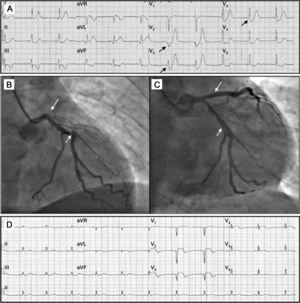 A: Elektrokardiogram ved 30 minutter etter smertestart; De Vinterkomplekser kan ses I ledninger V2-V4. B: Okklusjon av venstre fremre synkende arterie (piler) og signifikant stenose av circumflexarterien(skyggefulle piler). C: Koronar angiografi etter angioplastikk; reperfusjon av venstre fremre synkende arterie (pil) og circumflex lesjon etter behandling (skyggelagt pil) kan observeres. D: Elektrokardiogram etter prosedyren; bilde av utfallet av det fremre infarkt, Med q-bølger I ledninger V1-V2 og vedvarende forhøyning AV st-segmentet I ledninger V2-V5, I og aVL.