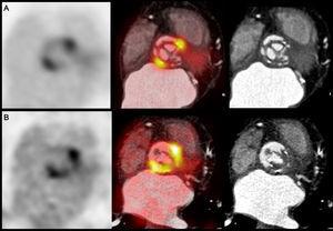 Positron emission tomography with fluorodeoxyglucose (18F-FDG PET) and cardiac computed tomography in the evaluation of prosthetic endocarditis. A: 18F-FDG PET slices, PET/CT fusion, and cardiac CT at the level of the aortic valve prosthesis, showing intense focal glucose hypermetabolism in the periannular region. B: 18F-FDG PET slices, PET/CT fusion, and cardiac CT at the supravalvular level, where the existing vegetations and the larger periannular area of 18F-FDG uptake can be observed.