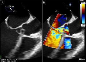 A: 2-dimensional transesophageal echocardiography. B: Color Doppler in midesophageal plane at 130°, showing massive aortic regurgitation secondary to eversion and rupture of the noncoronary aortic cusp in a patient with acute severe heart failure.