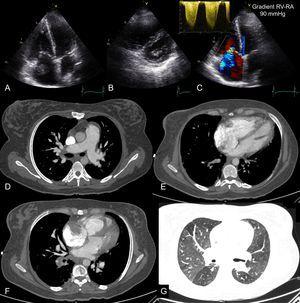 Echocardiography and computed tomography in a patient with acute pulmonary thromboembolism and chronic thromboembolic disease. Images from transthoracic echocardiography in apical planes (A and C) and short axis parasternal planes (B) showing severe dilatation of the right cavities and image of thrombus in right atrium. The continuous spectrum Doppler of tricuspid regurgitation is compatible with severe pulmonary hypertension (C). D: pulmonary angiography showing filling defects in segmental pulmonary branches compatible with acute pulmonary thromboembolism and dilatation of pulmonary arterial trunk as a sign of precapillary pulmonary hypertension. E: 4-chamber axial plane showing severe left ventricular dilatation, with an right ventricle/left ventricle ratio > 1. F: imaging compatible with right atrium thrombus. G: mosaic attenuation pattern of pulmonary parenchyma as a sign of precapillary pulmonary hypertension. RA, right atrium, RV, right ventricle.