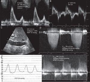 Estimation of left filling pressures using Doppler echocardiography in a patient with dyspnea and normal left ventricular function. A: pulsed-Doppler of mitral filling showing a restrictive filling pattern. B: tissue Doppler of lateral mitral annulus, allowing estimation of E/e’ ratio > 15. C: Subcostal plane of inferior vena cava. D: continuous Doppler of tricuspid regurgitation and estimation of pulmonary systolic pressure. E: pulmonary capillary pressure signal obtained with Swan-Ganz catheter. F and G: Doppler of pulmonary regurgitation and estimation of diastolic pulmonary pressure. DPAP, diastolic pulmonary artery pressure; DT, deceleration time of early mitral filling; IVC, inferior vena cava; PA, pulmonary artery; PCP, pulmonary capillary pressure; PR, pulmonary regurgitation; RA, right atrium; RAP, right atrial pressure; RV, right ventricle; SPAP, systolic pulmonary artery pressure; TR, tricuspid regurgitation; Vmax, maximal velocity. A wave, maximal velocity of late (atrial) mitral filling. E wave, maximal velocity of early mitral filling. e’ wave, protodiastolic velocity of lateral mitral annulus.