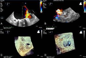 Patient with mechanical mitral prosthesis who was admitted for acute heart failure and increased transprosthetic mitral gradient. Transesophageal study showed severe paravalvular mitral regurgitation at the anteroseptal level. A: 2-dimensional color Doppler imaging in midesophageal plane. B: 3-dimensional color Doppler echocardiography imaging in real time; percutaneous closure was monitored using 3-dimensional transesophageal echocardiography in real time. The sheath can be seen crossing the paravalvular dehiscence (C). The moment in which the device is about to be released (D) can also be seen.