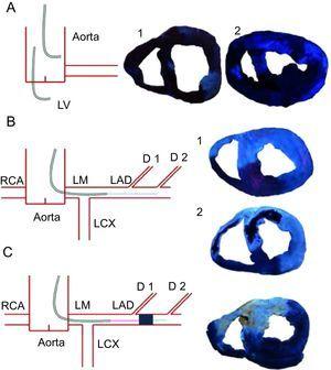 Methodology used for thioflavin-S infusion. Left, diagrams summarize the different methods used for thioflavin-S infusion. Right, pictures obtained under blue ultraviolet light. A: infusion in aorta (1) or in the left ventricle (2) resulted in a poor definition of the left anterior descending coronary artery-perfused area and microvascular obstruction. B: infusion into the catheter engaged in the proximal left anterior descending coronary artery resulted in a perfect definition of the left anterior descending coronary artery-perfused area and microvascular obstruction. This method was used in the control group (1) and in the 1-min, 1-week (2), and 1-month reperfusion groups. Light blue points represent the site of thioflavin-S infusion. C: infusion into the mid left anterior descending coronary artery through the lumen of an over-the-wire angioplasty balloon that was maintained inflated throughout the entire experiment resulted in a perfect definition of left anterior descending coronary artery-perfused area. This method was used in the no reperfusion group. D, diagonal; LAD, left anterior descending coronary artery; LCX, left circumflex artery; LM, left main stem; LV, left ventricle; RCA, right coronary artery.