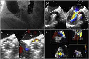 A: Significant paravalvular aortic regurgitation after implantation of a 26-mm aortic CoreValve® prosthesis, probably due to major focal calcification at the posterior site. B: 180° transesophageal echocardiography showing paravalvular leak at the posterior site with severe paravalvular aortic regurgitation. C: 18° (short axis) transesophageal echocardiography showing a crescent-shaped paravalvular leak at the posterior site. D: Reconstruction and measurement of the paravalvular leak with 3-dimensional transesophageal echocardiography (9×4mm). LA, left atrium.