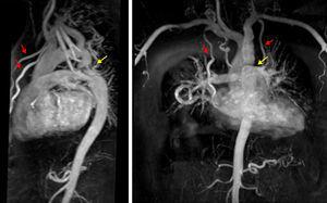 Contrast enhanced magnetic resonance angiography of descending aorta in an adult patient with aortic coarctation (yellow arrows) and expressed collateral flow through internal mammary arteries (red arrows).