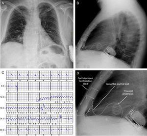 A and B: Posterior-anterior and lateral chest X-ray after removal of transvenous system and implantation of tricuspid mechanical prosthesis and subcutaneous implantable cardioverter-defibrillator. C: Recording of ventricular fibrillation induction test with the subcutaneous implantable cardioverter-defibrillator. D: Details of the tricuspid prosthesis, the epicardial lead for potential pacing, and the lead and generator of the subcutaneous implantable cardioverter-defibrillator.