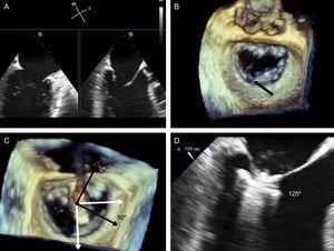 Implantation plane. The geometry of this mitral valve shows the intercommissural view at 60° (A), and therefore the left ventricular outflow tract is at 150°. However, due to the marked indentation separating P1 from P2 (B, arrow), the implantation plane is slightly angulated. To locate the implantation plane, 3-dimensional transesophageal echocardiography must be used to first confirm coaxial alignment with the target zone (C); then the 2-dimensional view must be sought by moving the transducer, to achieve the best view of both open arms (D).