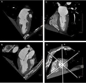 Multiplane reconstruction in cardiac computed tomography. Note the excellent spatial resolution on all 3 planes, permitting a detailed analysis of the entire mitral valve apparatus. A: vertical longitudinal plane of the heart. B: 3-chamber plane with the left ventricular outflow tract. C: horizontal longitudinal plane of the heart. D: short axis of the heart, sliced by the other 3 planes (a-c).