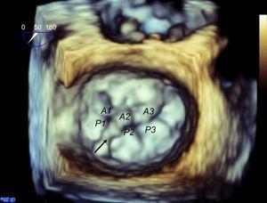 Mitral valve from a surgical view. Three-dimensional transesophageal echocardiography of the mitral valve, providing rapid identification of all valve scallops and detection of a ruptured chord with flail leaflet, affecting scallop A2 alone.