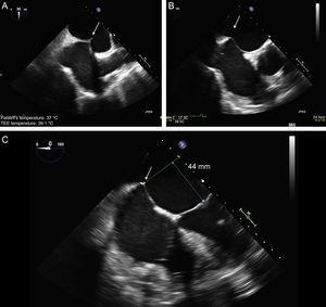 Two-dimensional transesophageal echocardiographic-guided transseptal puncture. A: bicaval view and puncture in the center of the fossa ovalis (arrow). B: short axis view of great vessels with posterior puncture (arrow), away from the aorta. C: 4-chamber plane to measure the height from the puncture site to the valve coaptation line, which should be about 45 mm.