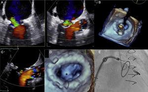 A: Severe mitral regurgitation following annuloplasty; B: Real-time 3-dimensional transesophageal echocardiogram showing perpendicularity of the clip with respect to leaflets and ring; C: Achievement of mild mitral regurgitation following clip implantation; D: 3-dimensional transesophageal echocardiogram showing a double orifice with the clip in between (asterisk); E: Fluoroscopic image showing the position of the implanted clip in relation to the annuloplasty ring.