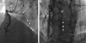 Anterior descending septal artery (arrows), which provides homocoronary collateral circulation (arrow heads) toward distal right coronary artery in the presence of an acute occlusion (A) and chronic occlusion (B) of right coronary artery.